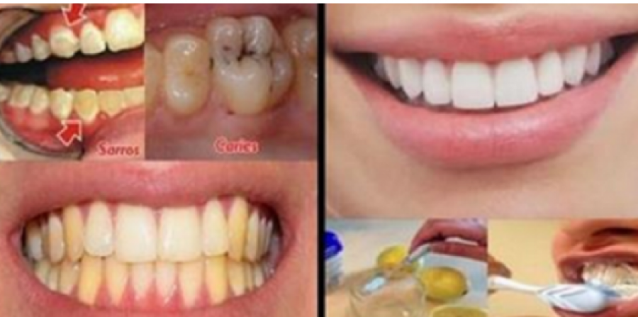 Lamtumirë dentist! Çfarë duhet të bëni për të pasur dhëmbë perfektë
