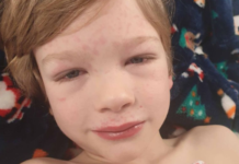 Ishte i infektuar me koronavirus, zbulohet sindroma e rrallë tek 7-vjeçari në Britani. Dyshohet se sëmundja vdekjeprurëse lidhet me Covid-19
