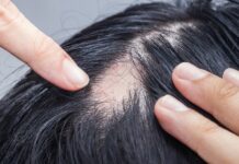 Alopecia Areata, si ta kuroni me metoda natyrale