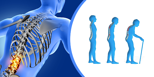Osteoporoza, diagnostikimi dhe trajtimi saj