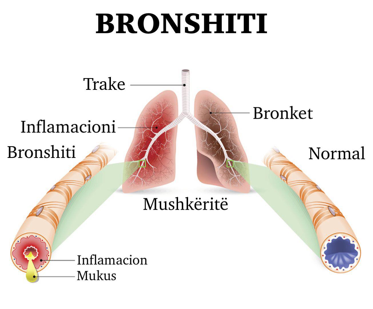 Si trajtohen kolla dhe bronkiti?