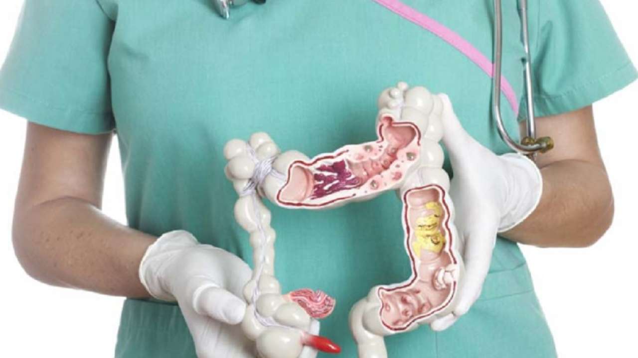 Njihuni me ushqimet e shëndetshme dhe ato të dëmshme që ndikojnë në infeksionin e zorrës së trashë