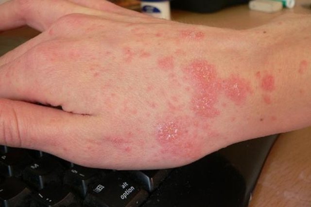 Shpërthen zgjebja në Shqipëri, mutacioni i ri infekton edhe të pastrit. Dermatologia tregon çfarë e mbyt parazitin