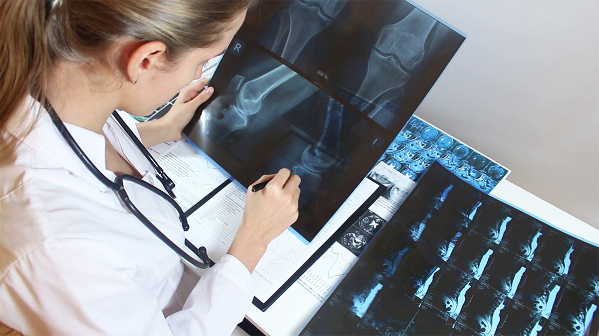 Tri shenjat paralajmëruese të osteoporozës që duhet t’i dini patjetër