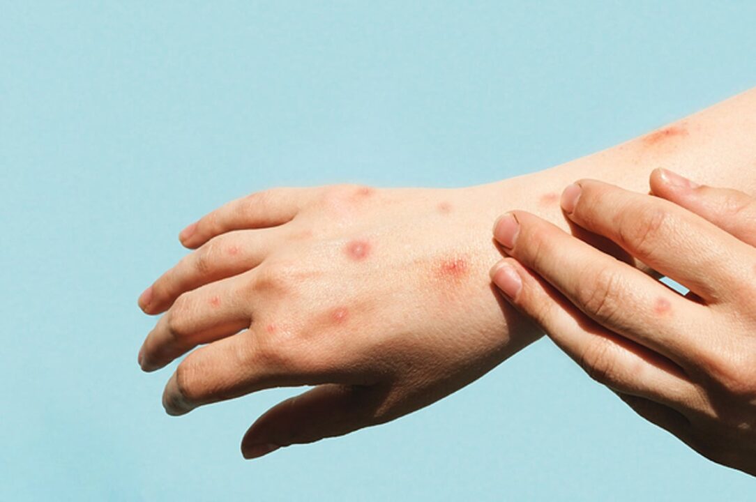 heres what you should know about monkeypox in chi 2 5950 1661800542 8 dblbig 1084x720 1