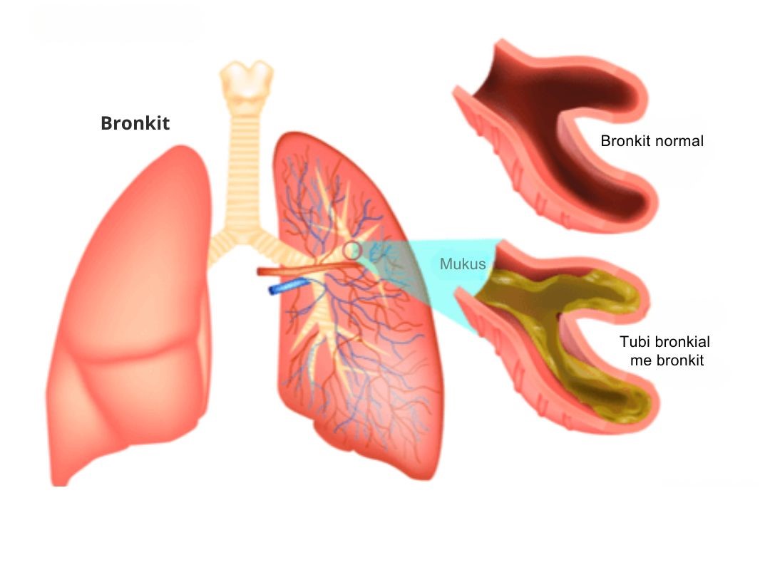 Bronkiti akut: A është ngjitës?