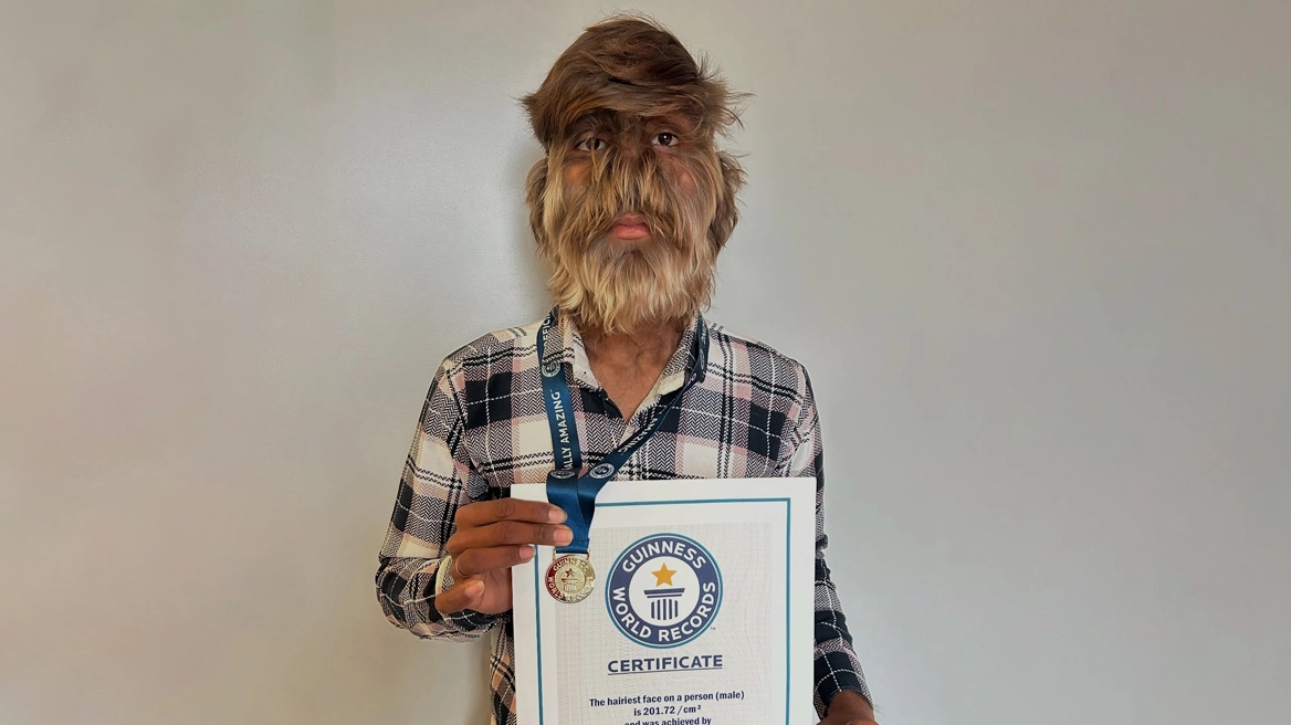 Adoleshenti me sindromën e ujkut hyn në Guinness