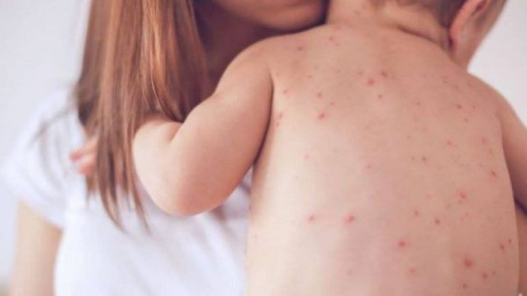 Mosvaksinimi solli shpërthim të fruthit, mjekët: 8% e fëmijëve nuk kanë marrë dozën e dytë