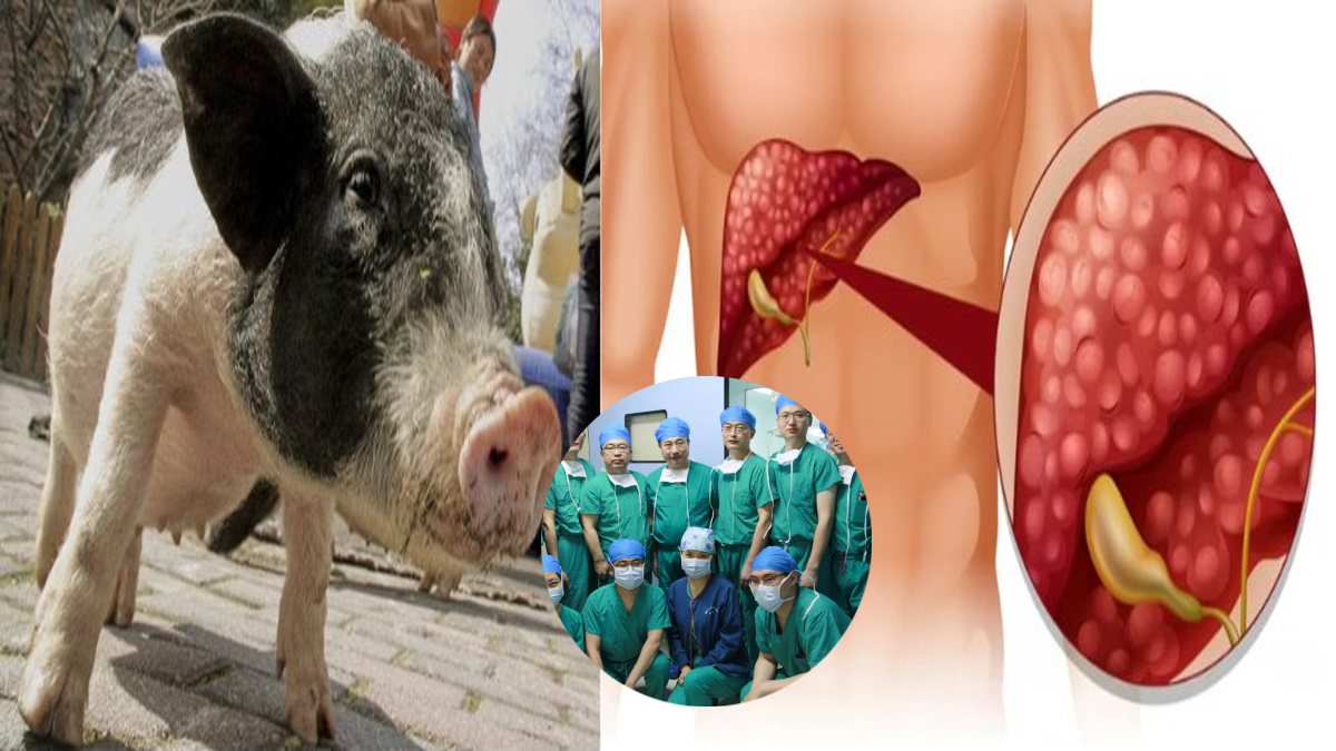 Burri në Kinë mbijeton gjashtë muaj pas transplantimit të mëlçisë së derrit