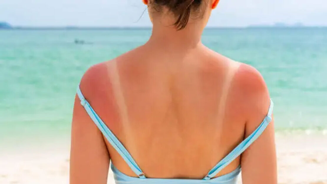 Si ta lehtësoni menjëherë djegien nga dielli me aloe vera