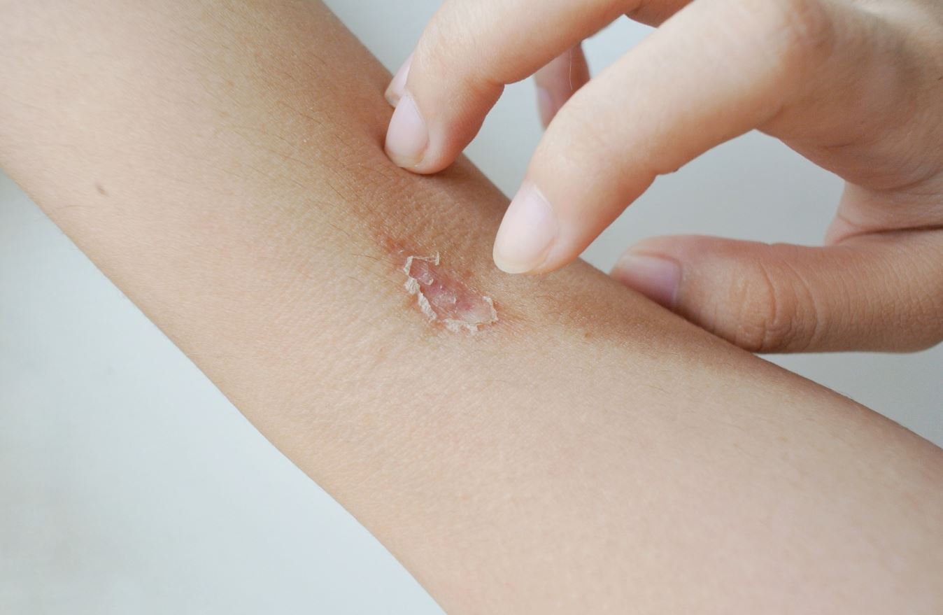 “Mos e nënvlerësoni” – Mjeku: Kujdes nga infeksioni i Impetigos, ja shenjat dhe mënyrat e trajtimit