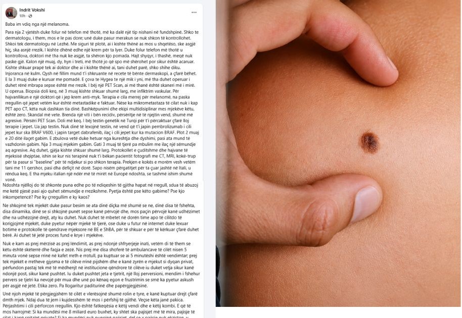 melanoma1