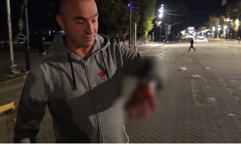 “Më gjuajtën me gurë dhe më hodhën gaz në sy”, protestuesi tregon dhunën nga policia: Do të vij sërish, kërkojmë të drejtat tona 2 protestuesi i gjakosur